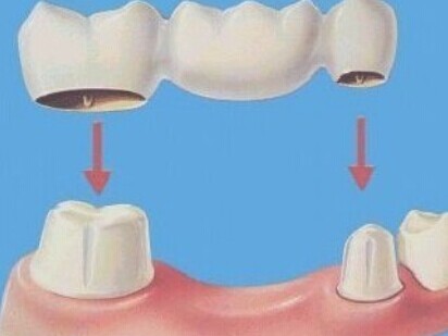 镶牙后为什么要护理牙龈