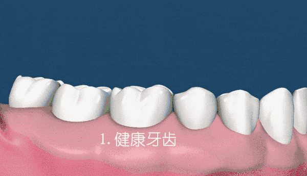 牙周炎历程.gif